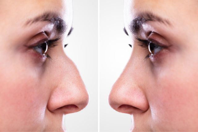 nose-youve-always-wanted-exploring-the-transformative-benefits-of-rhinoplasty