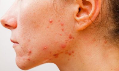how-to-test-for-acne