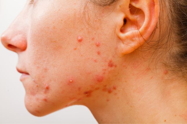 how-to-test-for-acne